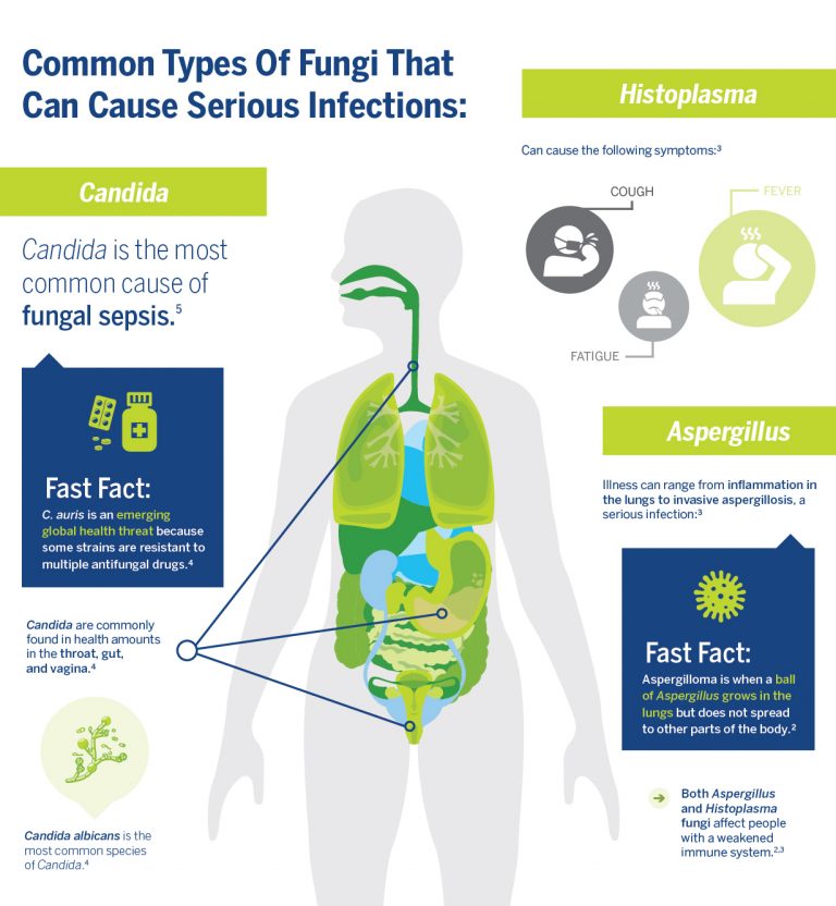 Invasive Fungal Infections Can Lead to Sepsis—And Have a High Mortality